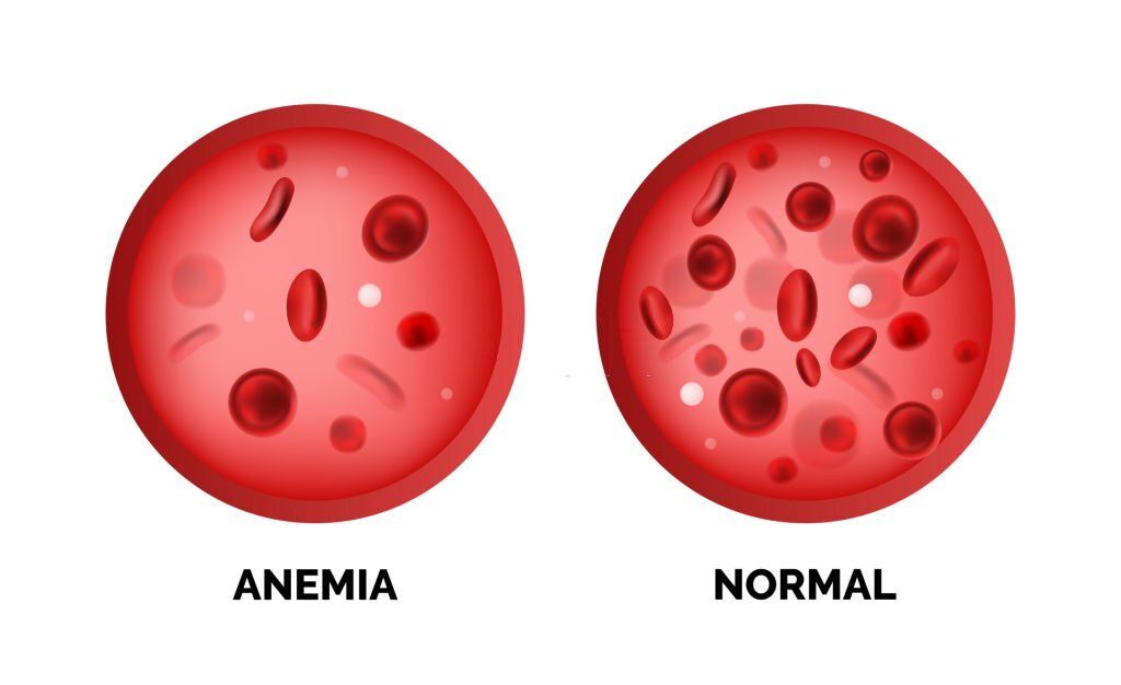 Infografía anemia
