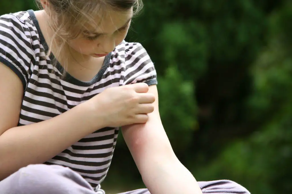 Alergia y reacción a la picadura del mosquito