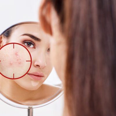 Soluciones caseras contra el acné