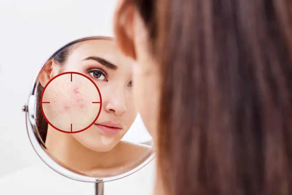 Soluciones y remedios caseros contra el acné